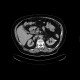 Kidney tumour, RFA: CT - Computed tomography